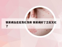 银屑病治愈后发红发痒 银屑病好了之后又红了