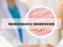 银屑病复发前兆可以 银屑病复发的迹象