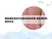 银屑病风湿关节炎现在疼的厉害 银屑病性风湿关节炎