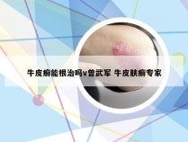 牛皮癣能根治吗v曾武军 牛皮肤癣专家