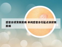 感冒会诱发银屑病 单纯感冒会引起点滴状银屑病