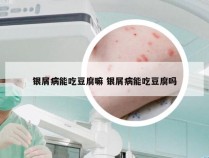 银屑病能吃豆腐嘛 银屑病能吃豆腐吗