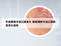 牛皮癣用卡泊三醇多久 银屑病用卡泊三醇软膏多久有效