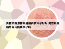 男性长期涂抹银屑病药物怀孕好吗 男性银屑病外用药能要孩子吗