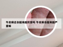 牛皮癣还会越来越厉害吗 牛皮癣会越来越严重嘛