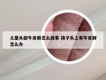 儿童头部牛皮癣怎么回事 孩子头上有牛皮鲜怎么办