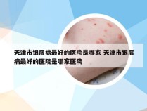 天津市银屑病最好的医院是哪家 天津市银屑病最好的医院是哪家医院