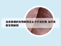 治皮肤病的生物制剂怎么个打法针数 治疗皮肤生物制剂