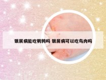 银屑病能吃鹌鹑吗 银屑病可以吃鸟肉吗