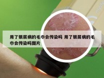 用了银屑病的毛巾会传染吗 用了银屑病的毛巾会传染吗图片