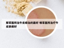 那家医院治牛皮癣治的最好 哪家医院治疗牛皮肤癣好