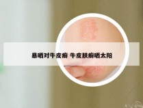 暴晒对牛皮癣 牛皮肤癣晒太阳