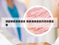 颈部银屑病用激素 银屑病用激素药膏效果显著