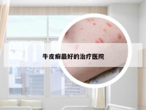 牛皮癣最好的治疗医院