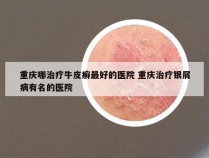 重庆哪治疗牛皮癣最好的医院 重庆治疗银屑病有名的医院