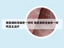 银屑病和荨麻疹一样吗 银屑病和荨麻疹一样吗怎么治疗
