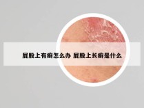 屁股上有癣怎么办 屁股上长癣是什么