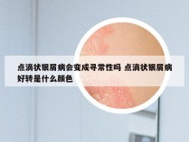 点滴状银屑病会变成寻常性吗 点滴状银屑病好转是什么颜色