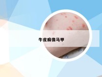 牛皮癣像马甲