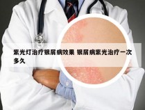 紫光灯治疗银屑病效果 银屑病紫光治疗一次多久