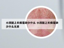 小孩腿上长癣是缺少什么 小孩腿上长癣是缺少什么元素