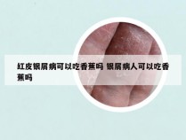 红皮银屑病可以吃香蕉吗 银屑病人可以吃香蕉吗