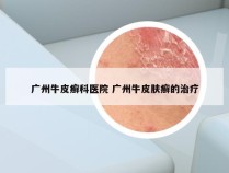 广州牛皮癣科医院 广州牛皮肤癣的治疗