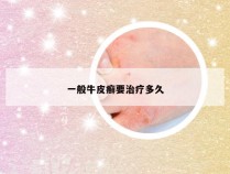 一般牛皮癣要治疗多久