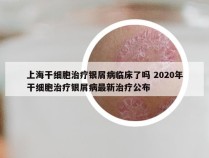 上海干细胞治疗银屑病临床了吗 2020年干细胞治疗银屑病最新治疗公布