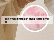 宿迁牛皮癣医院哪家好 宿迁皮肤性病治疗医院