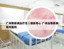 广州银屑病治疗先詢康肤用心 广州治银屑病有效医院