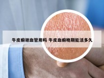 牛皮癣谢血管用吗 牛皮血癣晚期能活多久