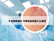 牛皮癣眼睛红 牛眼皮起癣是什么原因