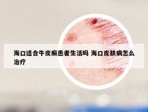 海口适合牛皮癣患者生活吗 海口皮肤病怎么治疗