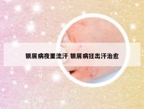 银屑病夜里流汗 银屑病狂出汗治愈