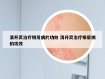 清开灵治疗银屑病的功效 清开灵治疗银屑病的功效