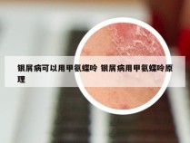 银屑病可以用甲氨蝶呤 银屑病用甲氨蝶呤原理