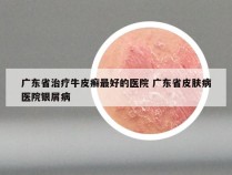 广东省治疗牛皮癣最好的医院 广东省皮肤病医院银屑病