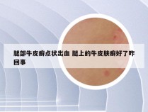 腿部牛皮癣点状出血 腿上的牛皮肤癣好了咋回事