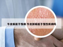 牛皮癣属于慢病 牛皮肤癣属于慢性疾病吗