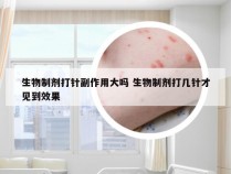 生物制剂打针副作用大吗 生物制剂打几针才见到效果