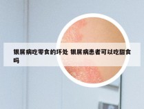 银屑病吃零食的坏处 银屑病患者可以吃甜食吗