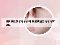 银屑病能偶尔吃羊肉吗 银屑病适当吃羊肉可以吗
