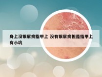 身上没银屑病指甲上 没有银屑病但是指甲上有小坑