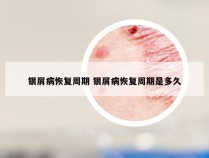 银屑病恢复周期 银屑病恢复周期是多久