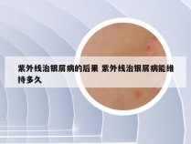 紫外线治银屑病的后果 紫外线治银屑病能维持多久