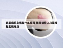 银屑病脸上很红什么原因 银屑病脸上总是反复出现红点