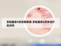 多粘菌素b软膏银屑病 多粘菌素b软膏治疗皮炎吗