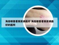 海南哪里看银屑病最好 海南哪里看银屑病最好的医院