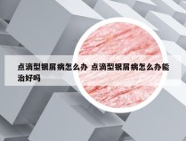 点滴型银屑病怎么办 点滴型银屑病怎么办能治好吗